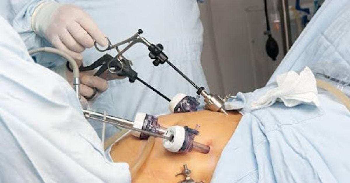 Gastric Sleeve Surgery in Gold Coast